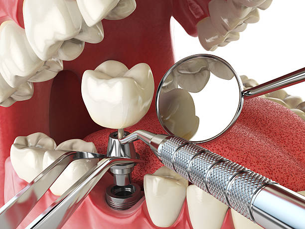 Best Emergency Treatment for Toothache in Bossier City, LA
